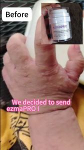 Ready stock🇲🇾Ezmapro Herbal Cream for Itchy Sensitive