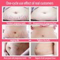 Stretch mark cream scar remover cream Stretch Marks Remover Skin Repair Cream 50g Special for Pregnancy Postpartum Care Remove pregnancy scars. 