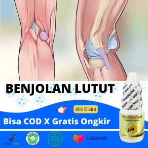 Obat Penghilang Benjolan Di Lutut Benjolan Tapi Gak Sakit Penghancur Tonjolan Kista Pada Persendian Tulang Lutut Kista Baker Ganglion Minyak Oles Sakit Kelenjar Berair Bernanah Cenang Bisul Herbal Benjolan Paha Selangkangan - Propolis Sm 6 Ml