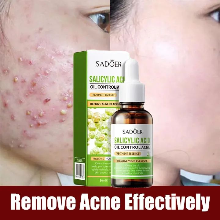 100% Effective Acne Removal Salicylic Acid Serum Genuine Skin Care 30ml