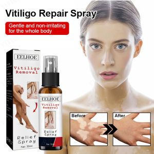 Herbal Vitiligo Repair Spray Skin Care