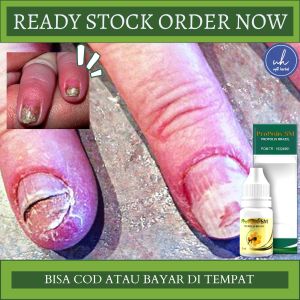 Obat Jamur Kuku Obat Penghilang Jamur Kuku Obat Oles Kuku Rusak Obat Infeksi Jamur Obat Kuku Bau Obat Kuku Menghitam Obat Kuku Bernanah Kering Ngelupas Obat Perawatan Kuku Anak Dan Dewasa Obat Pencegahan Jamu Kuku Dengan Propolis SM