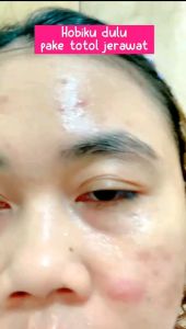 Paket Acne Sensitif BG Skin: Solusi Perawatan Kulit Wajah