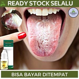 Obat Lidah Putih Obat Lidah Berjamur Obat Lidah Pecah Pecah Obat Lidah Luka Obat Lidah Mati Rasa Obat Kandidiasis Obat Lidah Sariawan Obat Lidah Putih Bau Obat Pembersih Lidah Berjamur Obat Infeksi Jamur Obat Perawatan Mulut Dengan Propolis SM