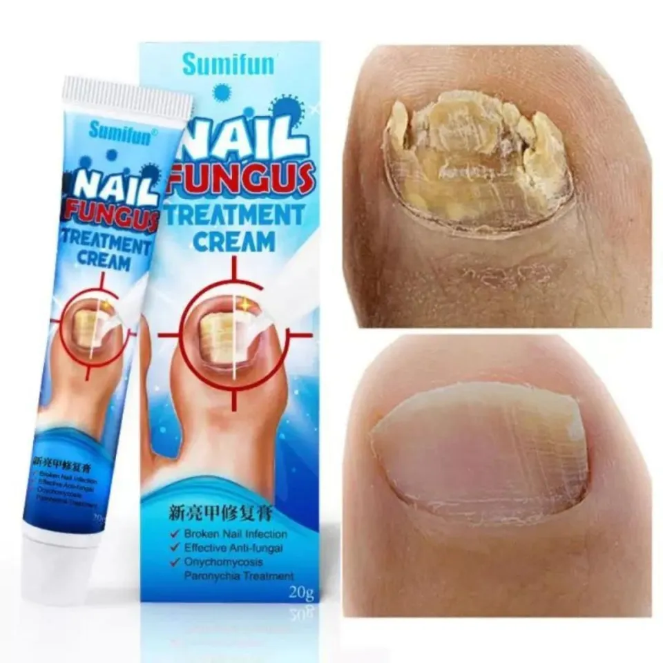 sumifun nail fungus removal cream onychomycosis| Alibaba.com