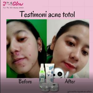 Jglow Skincare Paket Extra Acne Totol /  Perawatan Wajah Extra Acne Totol / ORIGINAL / TERLARIS / BEST SELLER / SUBANG