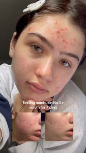 Serum dưỡng sáng mờ thâm Numbuzin No.5 Vitamin Concentrated 30ml