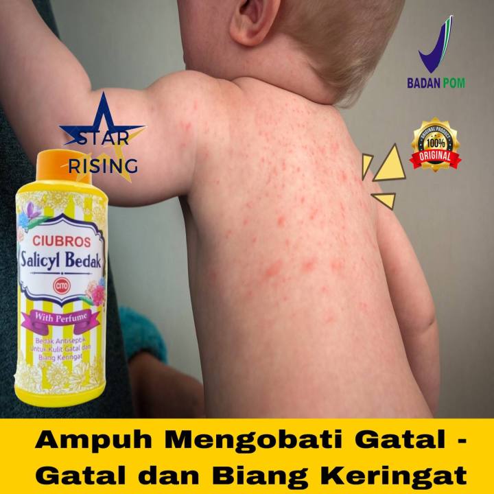 Ciubros Salicyl Bedak Cito  Bedak Gatal & Biang Keringat  Alergi dan  Biang Keringet Baby Powder Mengurangi Iritasi Kulit Bayi, Kulit Bayi Merah-Merah Gatal-Gatal