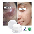 Penghilang Flek Hitam Paling Ampuh BPOM Salep Flek Hitam Ampuh Untuk Menghilangkan Flex Hitam Melasma Salep Flek Melasma Membandel Krim Penghilang Flek Hitam Di Wajah Permanen Cream Flek Khusus Flek Bandel Glowing Cream Leika Penghilang Flek Hitam Melasma. 
