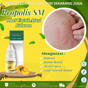 Propolis Sm - Obat Biduran Kaligata Alergi Dingin Biang Keringat Bintik Merah Jamur Di Kulit Kulit Ruam Merah