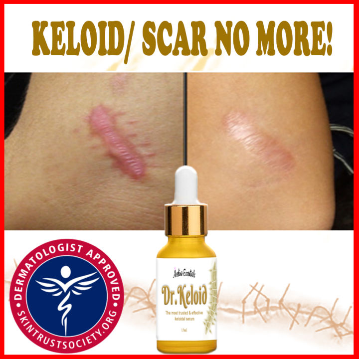 Dr Keloid Scar And Keloid Remover Serum Keloids Remover Scars Remover For Stretchmarks