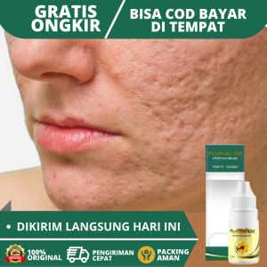 Obat Bopeng Berlubang Obat Bopeng Bekas Jerawat Obat Bopengan Obat Bopeng di Muka Obat Bopeng Parah Obat Penghilang Bekas Luka Bopeng Di Wajah Obat Milia Obat Bintik Di Wajah Obat Bruntusan Obat Kulit Wajah Tidak Rata Dengan  Propolis SM Brazil