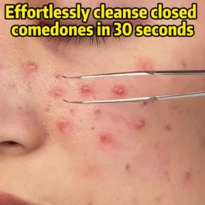 Acne Face Wash Blackhead Removal Moisturizer Pimple Salicylic Acid Cleanser Skincare