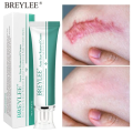BREYLEE Acne Scar Removal Cream Repair Stretch Marks Pimple Marks Skin Care. 