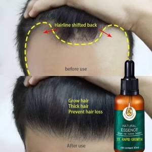 EELHOE Semprotan Penumbuh Rambut Hair Growth Serum Hair Growth Spray Repair Damaged Moisturizing Nutrition Baldness Prevention 30ml