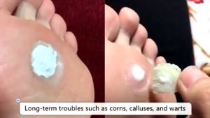 Best Seller Foot Corn Remover Ketuat Remover Corn Patch Ubat Ketuat Skin Tag Remover Patch Corn Caps Medicated Plasters Foot Care鸡眼贴COD