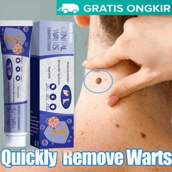 Wart Drugs Warten Mole Cholesterol Mole Removal Wart Cream Wart Removal ...