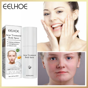 Eelhoe Acne Treatment Body Spray Soothing Body Lotion Spray Chicken Skin Snake Skin Cracking Moisturizing Hydrate Acne Treatment Body Mist Body Care Body Back Chest Face Acne Treatment Serum Liquid Spray Butt Skin Care Redness Calm Soothe Pores Shrink