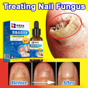 Nail fungus treatment Essence Japan Nail Repair Serum 100% Authentic Anti Infection Paronychia Onychomycosis Nail Foot Toe Nail Fungus Removal Effectively Repair Damaged Nails Remove Onychomycosis Promote Nails Growth 灰指甲精华30ML