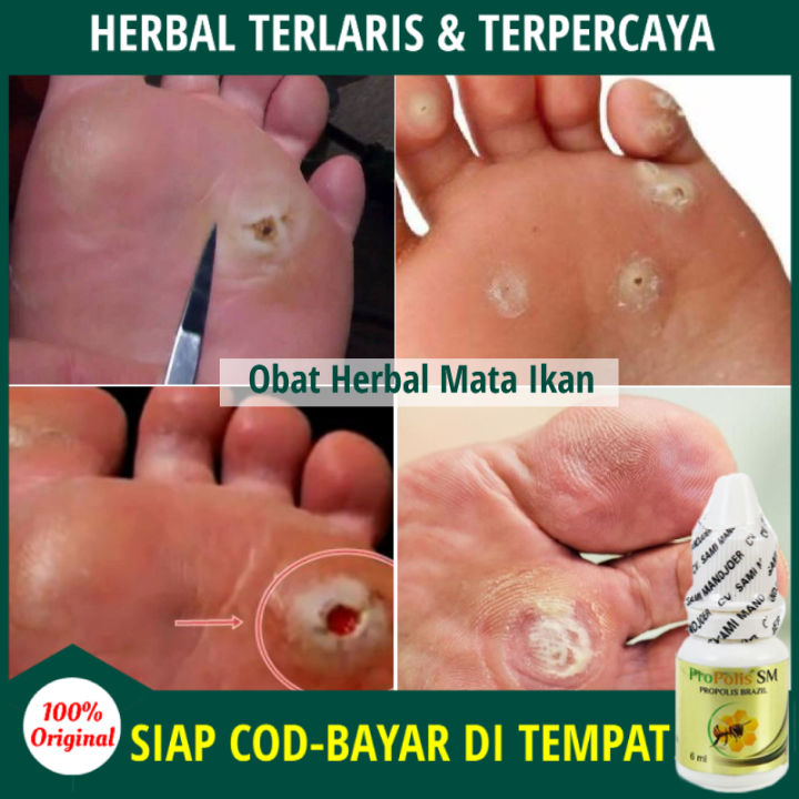Obat Mata Ikan di Telapak Kaki, Obat Mata Ikan di Kaki & Tangan, Salep untuk Menghilangkan Mata Ikan, Obat Oles Mata Ikan / Kutil / Kapalan / Clavus, Penghilang Benjolan Kecil Herbal, Infeksi Jamur Kulit, dgn Obat Tetes Mata Ikan Propolis SM [BISA COD]