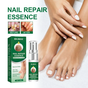 Toenail Repair Serum for Yellow Thick Ingrown Nails - Natural Solution Fungal Nail Treatment Strengthens Brittle Nails Restore Healthy Shine Gentle Formula Daily Care Essence