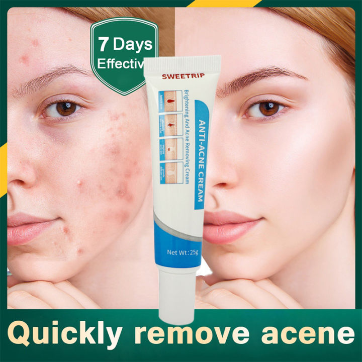 ointment Remover acne pimples Cream Fades Acne Marks Repairs Acne Pits Facial Scar Care remove pimples and dark spots Aloe Gelatine Pimple Eraser Acne Treatment Cream Acne Scar Remover Acne Repair Cream for face whitening cream