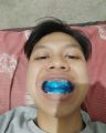 [TAHAP 1] Perapih gigi tonggos original asli Perapih gigi maju ke depan Behel gigi lepas pasang asli original Behel perapih gigi carang gingsul renggang asli dokter Alat perapih gigi monyong Alat perapih gigi maju ori Teeth Trainer Alignment Asli 100% ORI. 