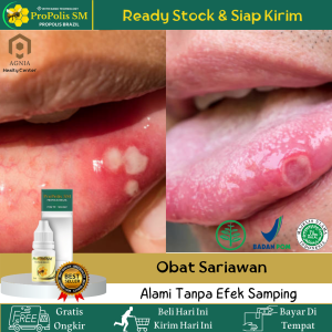 Obat Sariawan Obat Sariawan Di Bibir Obat Sariawan Di Lidah Obat Perih Di Lidah Obat Herbal Sariawan Obat Sariawan Mulut Dewasa Atasi Dengan Propolis SM 100% Original - Herbal Alami Tanpa Efek Samping