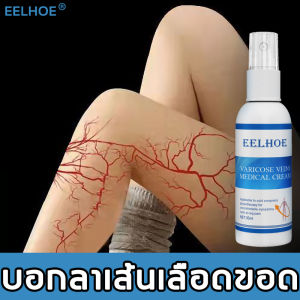 พ่นเดียว ขาเบา! ครีมทาเส้นเลือดขอด ครีมทาสำหรับเส้นเลือดขอด ขาสวย ลบเส้นเลือดขอด กลับคืนสุขภาพเท้า Varicose Vein Cream