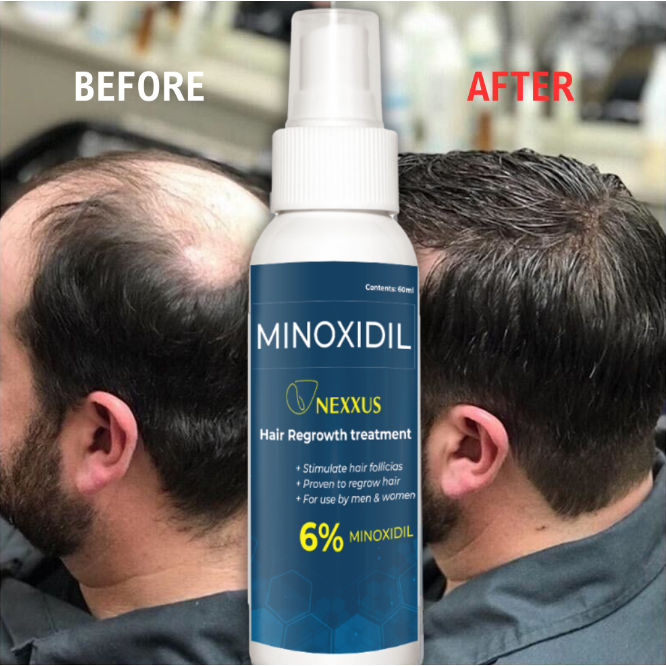 Minoxidil Strands 6% Minoxidil Topical Solution (60ml per bottle) Hair ...