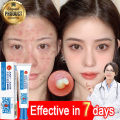 GL.25g Pimple Remover Cream Acne Removal Scar Marks Cream Acne Treatment Skin Cream Effective Anti-acne. 