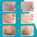 CeraVe Acne Cream Foaming Cleanser 4% Benzoyl Peroxide 150ml Pembersihan mendalam, kontrol minyak, memperbaiki jerawat wajah, komedo. 