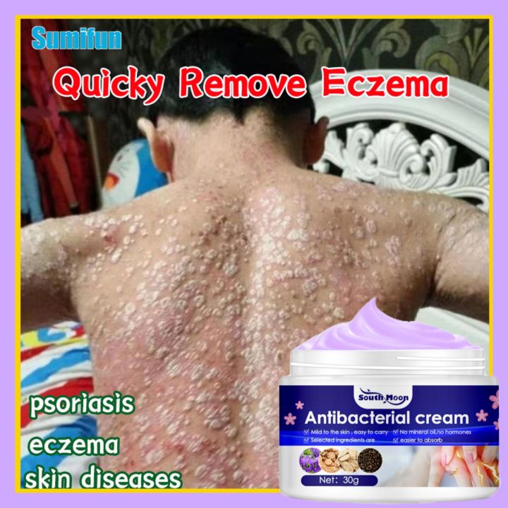 Gamot Sa Kati Kati Sa Balat Ointment Eczema Treatment Cream Atoderma ...