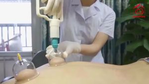 Bộ Giác Hơi 12 Món Không Dùng Lửa kèm dây nối Ống Bơm Chữa Đau Lưng Đầu Nhức Mỏi Điều Hoà Kinh Mạch Phukienprocare