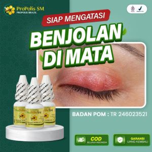 Obat Benjolan Di Kelopak Mata Obat Mata Bintitan Benjolan Bengkak Bisul Di Mata Propolis SM