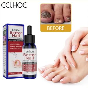 Tinh chất cho Nấm Móng Tay Chân Nail Fungal thẩm thấu nhanh khắc phục trong thời gian sớm/50ml