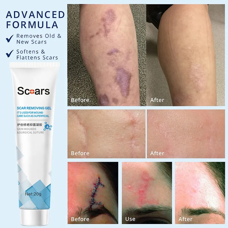 Scar Remover Gel Cream 20g Skin Repair Fade Acne Scars Remove