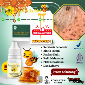 Obat Keratosis Seboroik Penghilang Bintik Hitam Di Kulit Keratosis Pilaris Kanker Kulit Melanoma Plak Kecoklatan Perawatan Kulit Dengan Propolis SM Brazilian Asli 100% Original