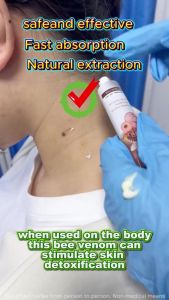 Best Seller Natural Bee Venom Skin Treatment Cream Quick Dissolve Plantar Wart Skin Tag COD