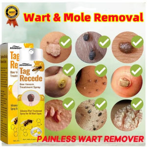Buang tahi lalat dan kutil Biji kolestrol remover wart removal Spray