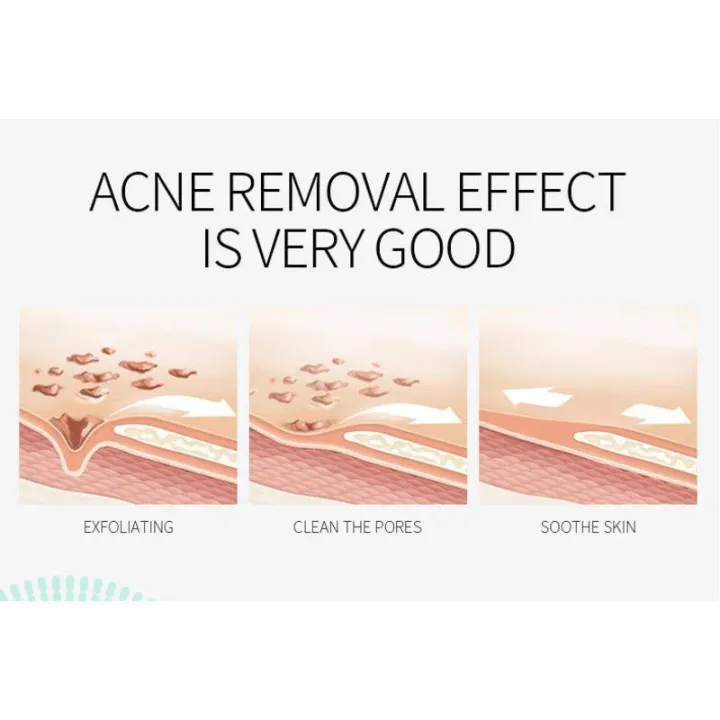 Crema facial para eliminar cicatrices de acné, tratamiento de belleza Aichun, crema antiacné para el cuidado de la piel, crema para los poros