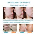 GL.25g Pimple Remover Cream Acne Removal Scar Marks Cream Acne Treatment Skin Cream Effective Anti-acne. 