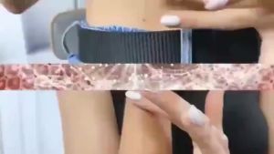 HXH - Authentic Scar Removal Miracle 50G | Leg Old Scar & Peklat Eliminator Stretch Marks Fast Fading