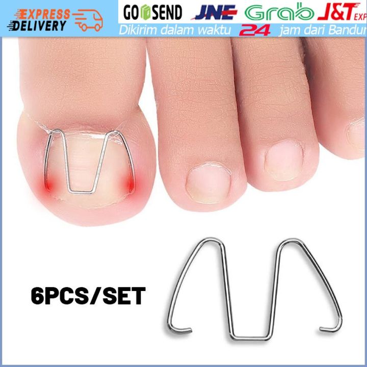 6Pcs Alat Korektor Kuku Kaki Cantengan / Toe Nail Ingrown Pedicure / Nail Corrector / Alat Koreksi Kuku Kaki Tumbuh Ke Dalam