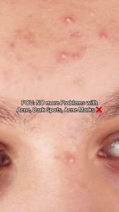 BIOAOUA 3% Salicylic Acid Acne Treatment Serum Pimple Remover Anti Acne Marks Oil Control 30ml