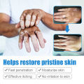 1 hari sembuh KADAI Salep Vitiligo 100% menghilangkan Menghambat Pertumbuhan Kulit Putih mengaktifkan melanin Meratakan Warna Kulit Untuk tubuh dan wajah formula jamu Tidak melukai kulit(vitiligo cream obat salep vitiligo vitiligo obat). 