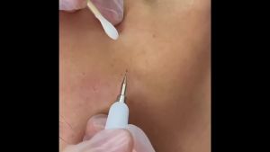 NEW Professional Tattoo Mole Removal Pen 30 Gears Plasma Pen Warts Skin Tag Remover Spot Cleaner Skin Tag Removal Machine