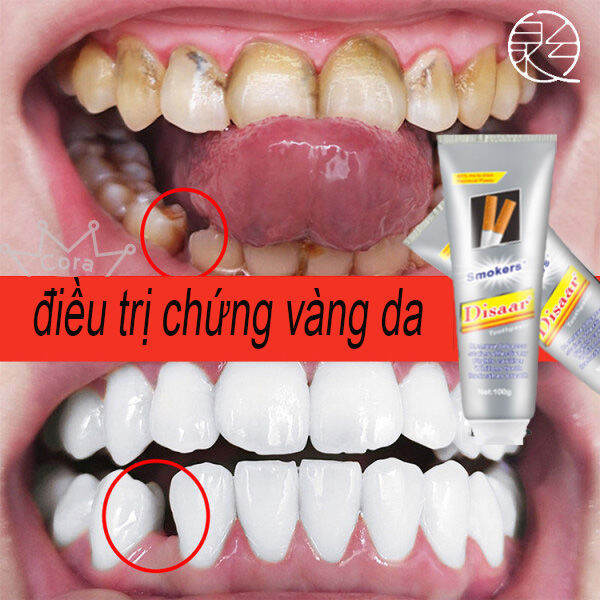 4. Lưu Ý Khi Sử Dụng Kem Đánh Răng Tẩy Ố Vàng