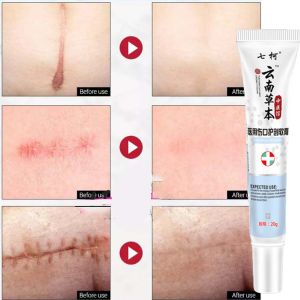 Kem Xóa Sẹo Sẹo Mụn Vết Rạn Da Gel Bỏng Sẹo Phẫu Thuật Cho Bộ Chỉnh Sắc Tố Cơ Thể Chăm Sóc Phục Hồi Sẹo Mụn