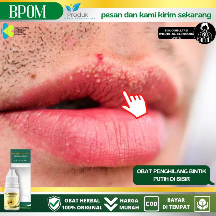 Obat Bintik Putih Di Bibir Obat Penghilang Bintik Putih Di Bibir Fordyce Spots Bintik Putih 5348